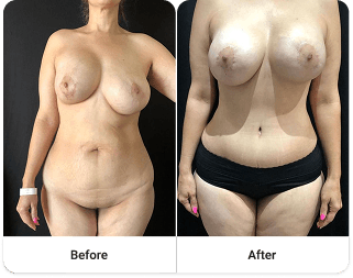 Before and after 1