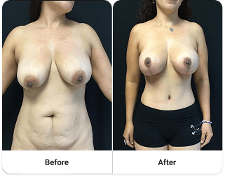 Before and after 5